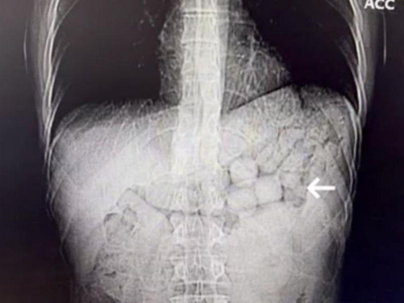 Diyarbakır’da Midelerinde Uyuşturucu Taşıyan 2 Kişi Tutuklandı (1)