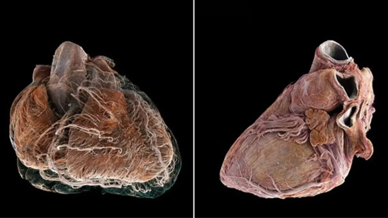 Kalp hastalıklarıyla mücadelede devrim: HiP-CT teknolojisi