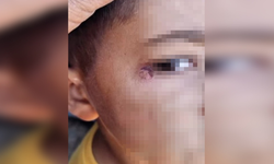 Şanlıurfa’da öğrenciyi darp edip yüzünde sigara söndürdü