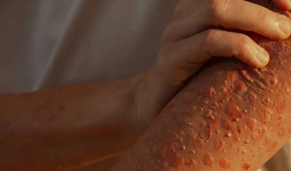 Türkiye’de maymun çiçeği alarmı: DSÖ ve NHS uyardı