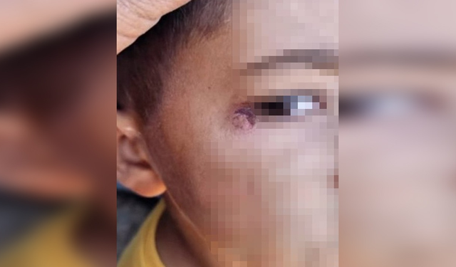 Şanlıurfa’da öğrenciyi darp edip yüzünde sigara söndürdü