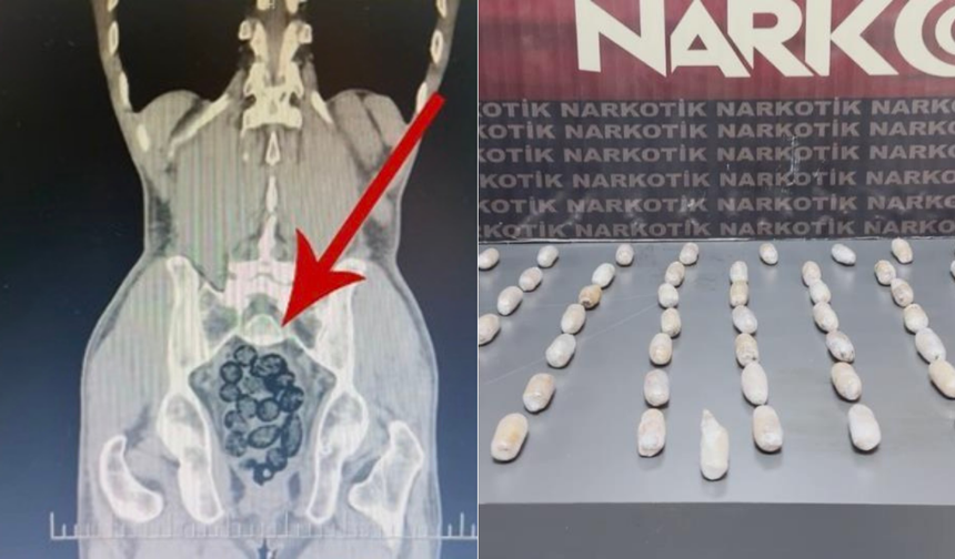 Yabancı uyruklu şahsın midesinden uyuşturucu çıktı